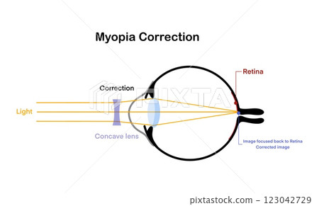 illustation of biology and physics, Diagram of myopia correction showing how a concave lens adjusts light rays to focus properly on the retina, explaining nearsightedness treatment 123042729