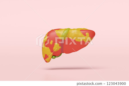 3d fatty liver disease isolated on pink background. 3d illustration render 3d fatty liver disease isolated on pink background. 3d illustration render 123043900