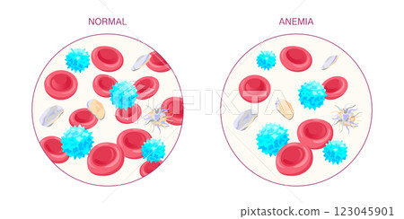 Anemia Blood Cells. Medical illustration comparing normal and anemic red blood cells with white blood cells and platelets. Normal and Anemic Blood Cells Illustration 123045901