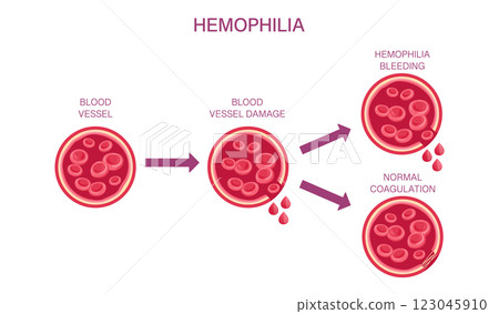 Hemophilia Blood Disorder. Vector medical infographic illustrating blood vessel damage, bleeding, and coagulation process. 123045910