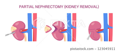 Partial Nephrectomy Surgery. Partial Nephrectomy Kidney Removal. Cross Section. Vector medical illustration of kidney removal procedure with incision, resection, and suturing. 123045911