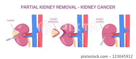 Partial Kidney Removal for Cancer. Vector medical illustration of nephrectomy surgery with tumor removal and suturing. Cross Section. 3D Illustration. 123045912