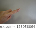 Wound on left index finger, 1 week after stitches were removed 123058864