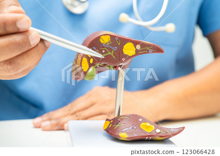 Cirrhosis, Liver cancer, fatty liver, Asian doctor with liver human anatomy model in World Hepatitis Day at hospital. 123066428