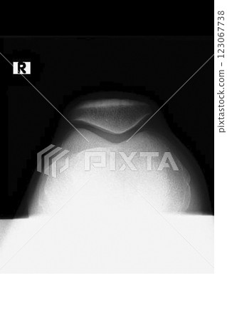 膝蓋的 X 光影像(庫存照片) 膝蓋的 X 光影像(庫存照片) 123067738