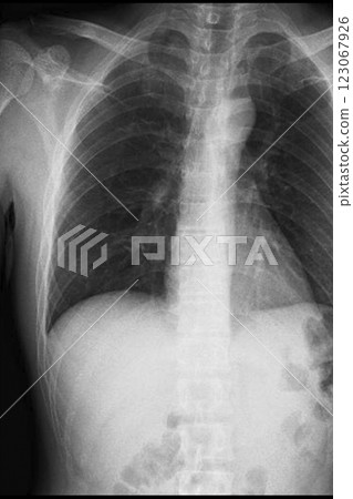 X-ray image of the chest and spine (stock photo) X-ray image of the chest and spine (stock photo) 123067926