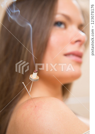 moxibustion acupunture needles heat on woman moxibustion acupunture needles heat on woman 123078176