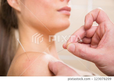 Doctor hands acupuncture needle pricking on woman Doctor hands acupuncture needle pricking on woman 123078209
