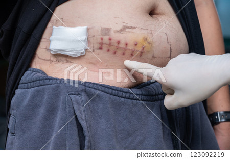 Cropped shot view of someone pointing to patient belly after Appendectomy surgery. 123092219