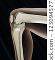 X-Ray, Total Knee Replacement is surgery to replace diseased or damaged joint surfaces of the knee with metal and plastic prosthetic devices 123094577