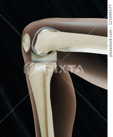 X-Ray, Total Knee Replacement is surgery to replace diseased or damaged joint surfaces of the knee with metal and plastic prosthetic devices X-Ray, Total Knee Replacement is surgery to replace diseased or damaged joint surfaces of the knee with metal and plastic prosthetic devices 123094577