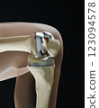 X-Ray, Total Knee Replacement is surgery to replace diseased or damaged joint surfaces of the knee with metal and plastic prosthetic devices 123094578