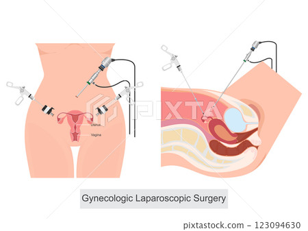Gynecologic Laparoscopic Surgery is a minimally invasive surgical procedure. Gynecologic Laparoscopic Surgery is a minimally invasive surgical procedure. 123094630