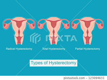 Hysterectomy is surgery to remove the uterus. 123094631