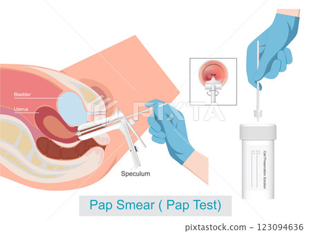 Pap Smear Cervical Cancer Screening. Pap Smear Cervical Cancer Screening. 123094636