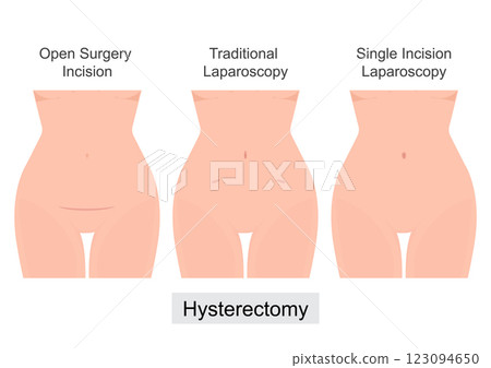 A Hysterectomy is a surgical removal of the uterus. A Hysterectomy is a surgical removal of the uterus. 123094650