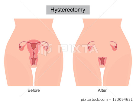 A Hysterectomy is surgery to remove the uterus. 123094651
