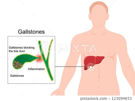 Gallstones are hardened deposits of bile. 123094653