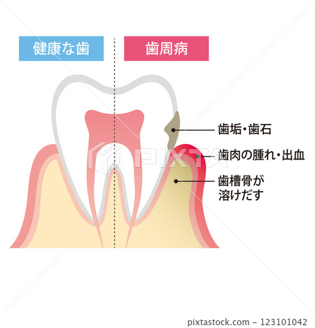 Illustration of healthy teeth and teeth with periodontal disease Illustration of healthy teeth and teeth with periodontal disease 123101042