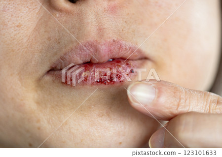 Stock photo of a woman touching herpes on her lip with her finger, applying ointment with her index finger Stock photo of a woman touching herpes on her lip with her finger, applying ointment with her index finger 123101633