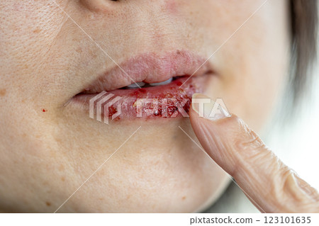 Stock photo of a woman touching herpes on her lip with her finger, applying ointment with her index finger Stock photo of a woman touching herpes on her lip with her finger, applying ointment with her index finger 123101635