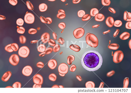 Iron deficiency anemia 123104707
