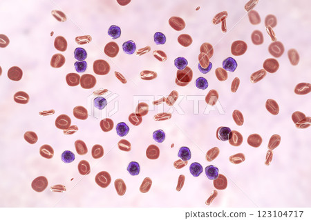 Acute lymphoblastic leukemia 123104717