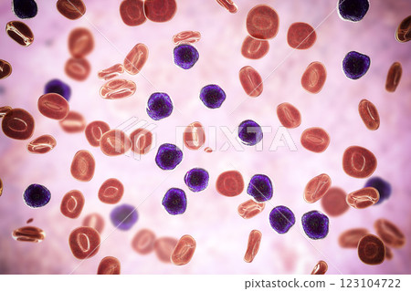 Acute lymphoblastic leukemia 123104722
