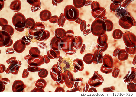 Polycythemia vera, a rare slow-growing blood cancer with an increase in the number of red blood cells Polycythemia vera, a rare slow-growing blood cancer with an increase in the number of red blood cells 123104730
