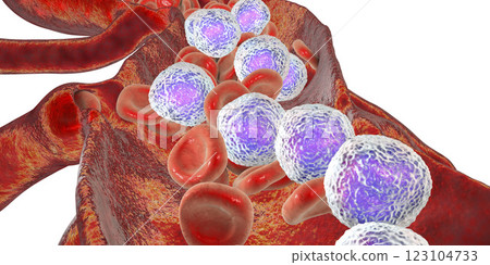 Acute lymphoblastic leukemia 123104733