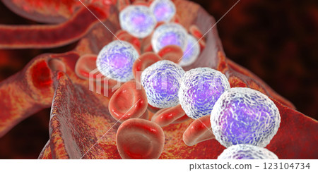 Acute lymphoblastic leukemia 123104734