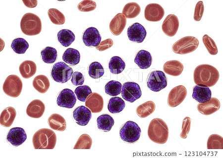 Acute lymphoblastic leukemia, bone marrow smear Acute lymphoblastic leukemia, bone marrow smear 123104737