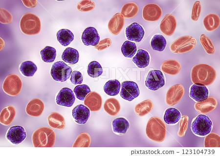 Acute lymphoblastic leukemia, bone marrow smear Acute lymphoblastic leukemia, bone marrow smear 123104739