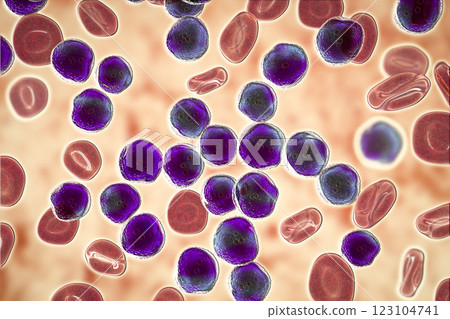 Acute lymphoblastic leukemia, bone marrow smear 123104741