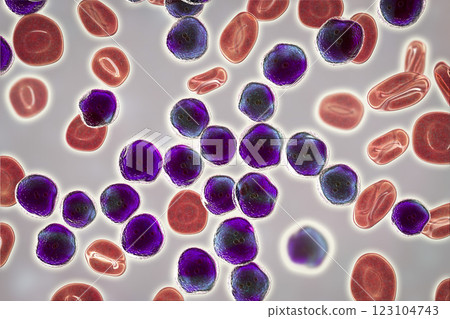 Acute lymphoblastic leukemia, bone marrow smear 123104743
