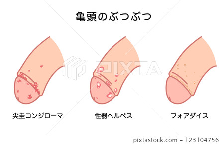 Bumps on male genitals - types of sexually transmitted diseases Bumps on male genitals - types of sexually transmitted diseases 123104756