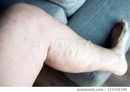 Caucasian woman with varicose saphenus vein 123105140