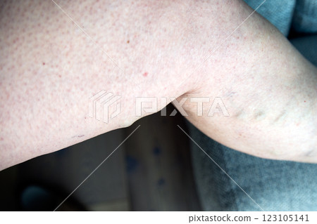Close up of varicose saphenus vein in a caucasian woman. 123105141