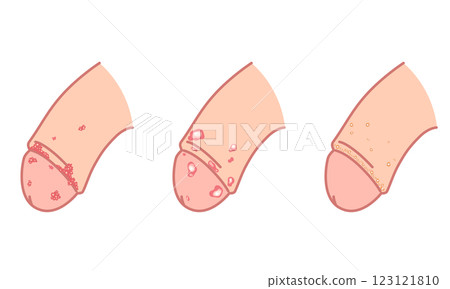 Bumps on male genitals - types of sexually transmitted diseases 123121810