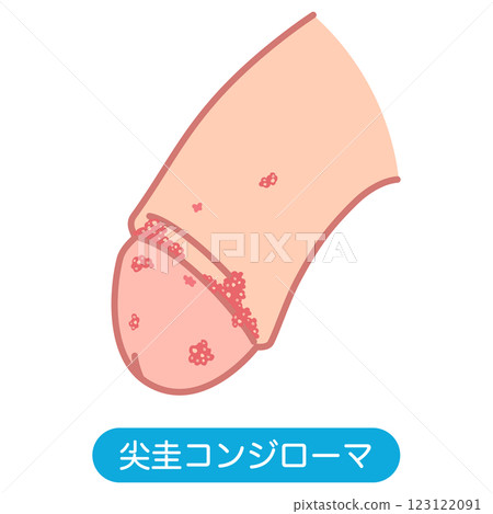 Genital warts: Bumps on the male genitals 123122091