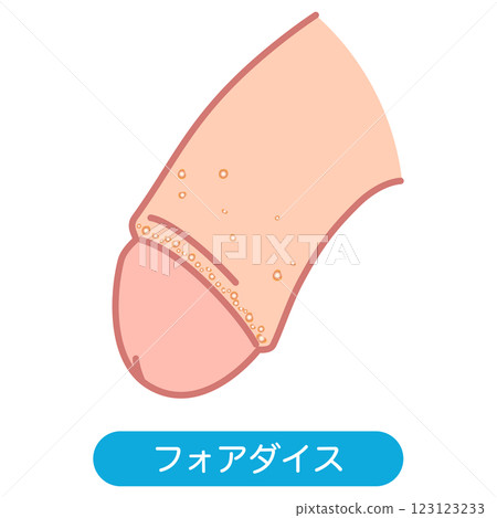 福代斯斑點：男性生殖器上的腫塊 123123233