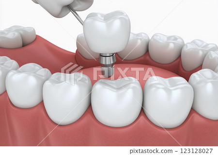 Dental implants displayed in a model of a human jaw demonstrating oral health and restoration procedures 123128027