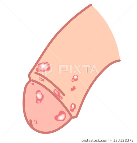 生殖器皰疹:男性生殖器上的腫塊 生殖器皰疹:男性生殖器上的腫塊 123128372