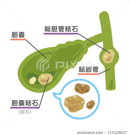 膽囊結石圖示 3 膽囊結石圖示 3 123129627