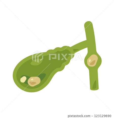 Illustration of a gallbladder with gallstones 1 123129690