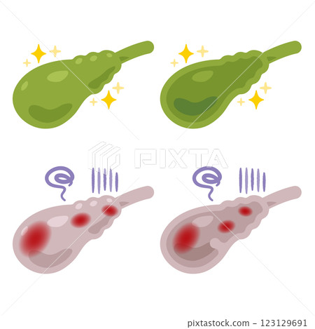 Illustration of a healthy and clean gallbladder and an inflamed and unhealthy gallbladder Illustration of a healthy and clean gallbladder and an inflamed and unhealthy gallbladder 123129691