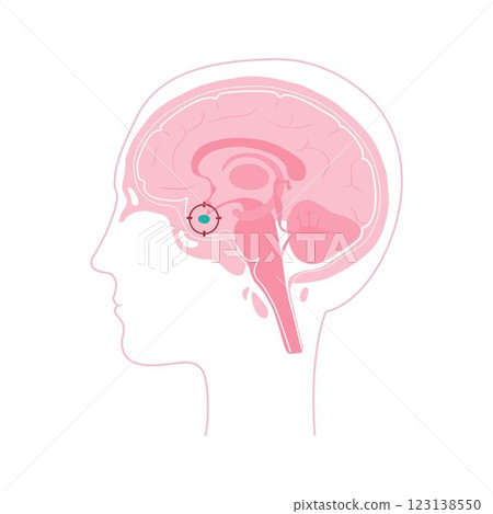 Pituitary adenoma, human head with brain. 123138550