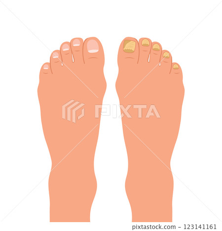 Nail disease. Onychomycosis concept. Fungal nail infection.  Medical illustration in flat design.  123141161