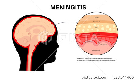 Meningitis medical poster Meningitis medical poster 123144400