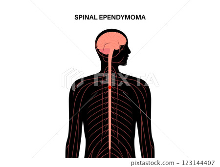 Spinal ependymoma cancer 123144407